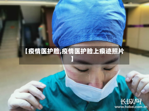 【疫情医护脸,疫情医护脸上痕迹照片】-第2张图片